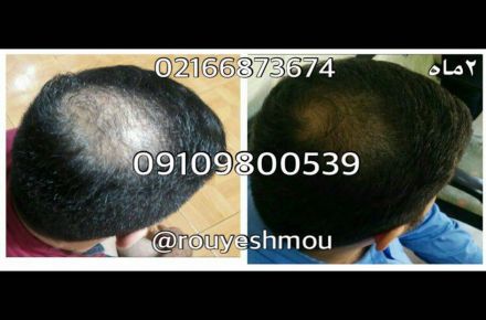 رشد طبیعی مو در ماه